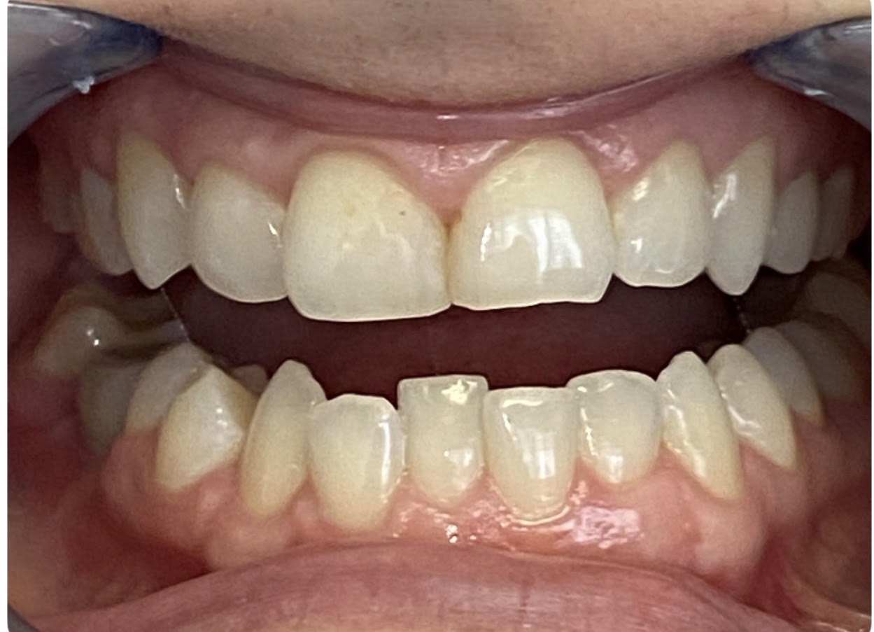 Invisalign alignment - before treatment