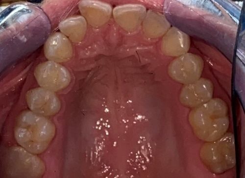 Invisalign upper arch result - before treatment