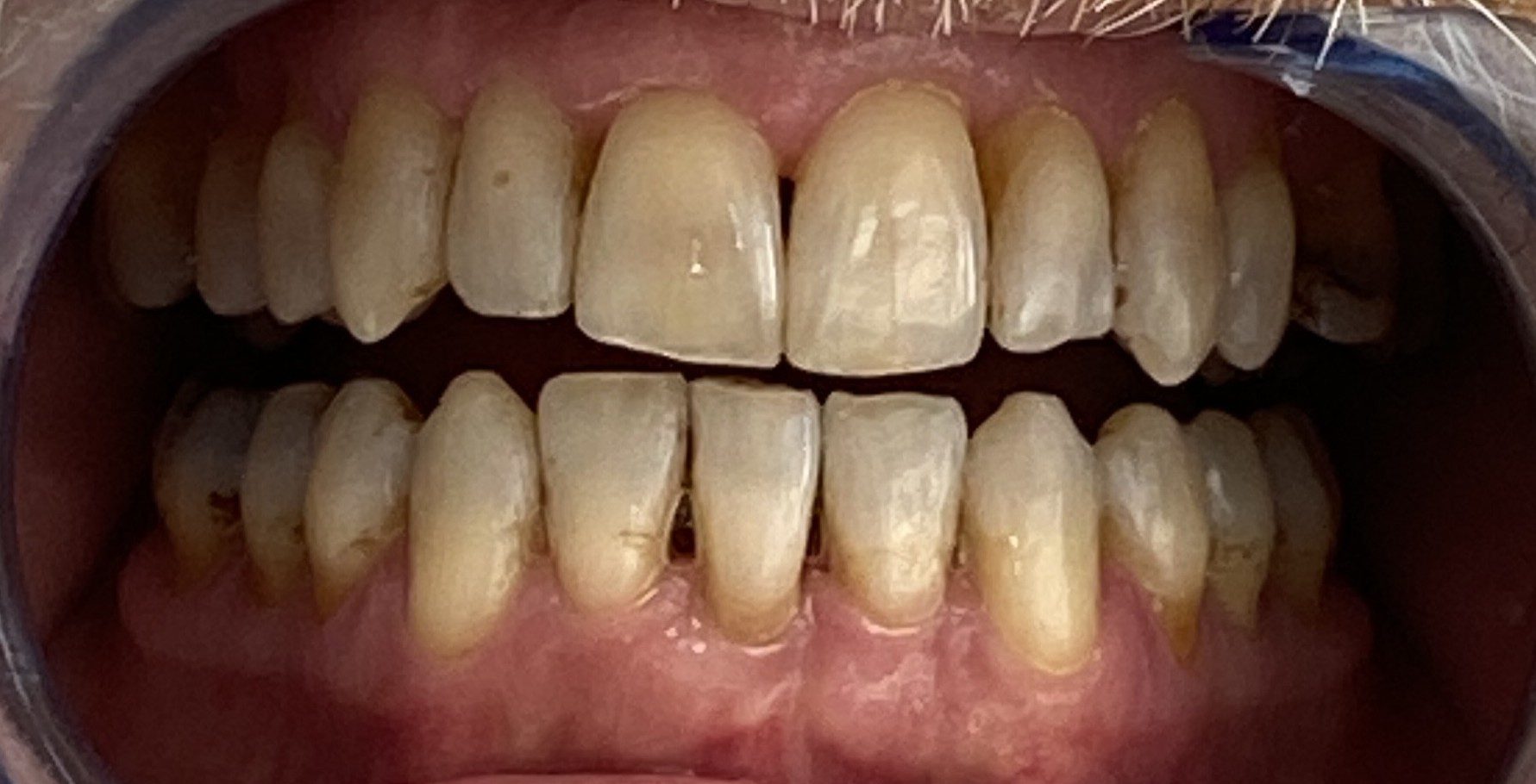 Invisalign result - after treatment