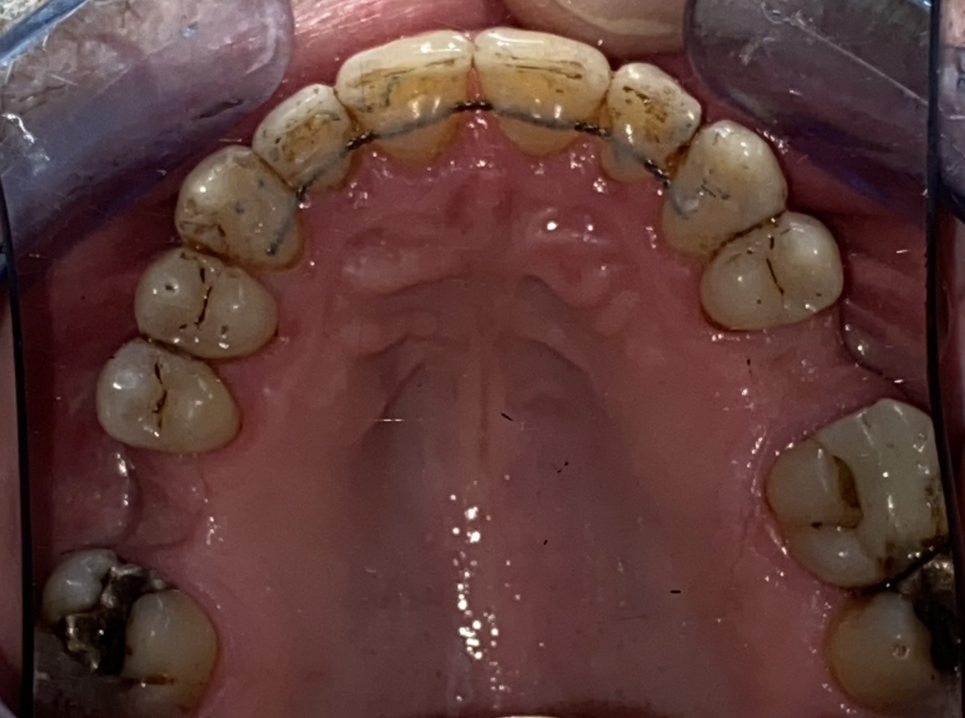 Invisalign upper arch result - after treatment