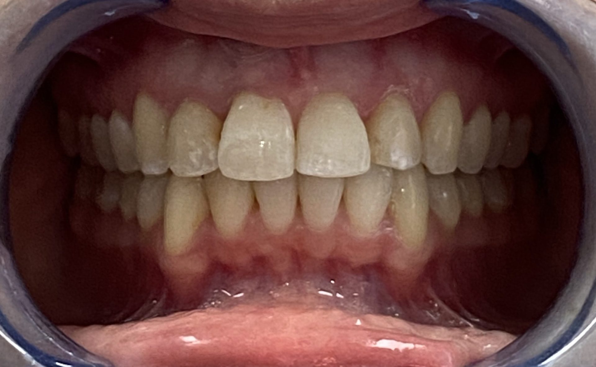 Invisalign treatment result - after treatment