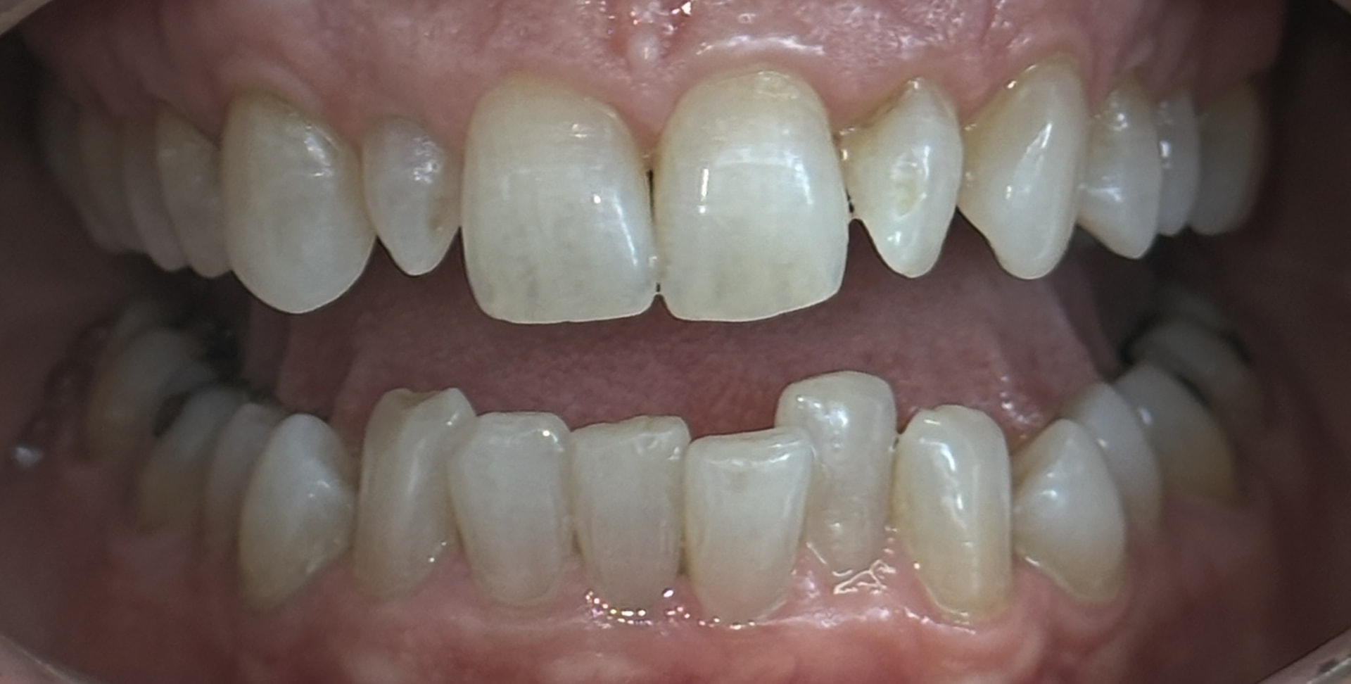 Invisalign, crowns and veneers - before treatment