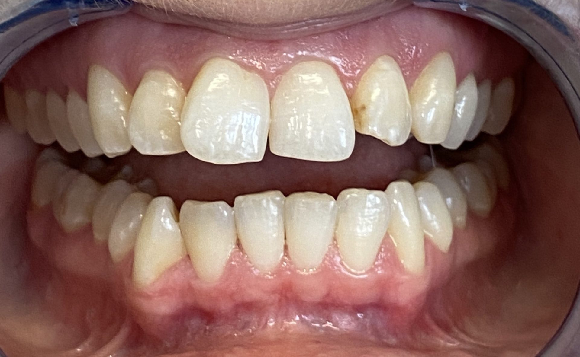 Invisalign treatment result - before treatment