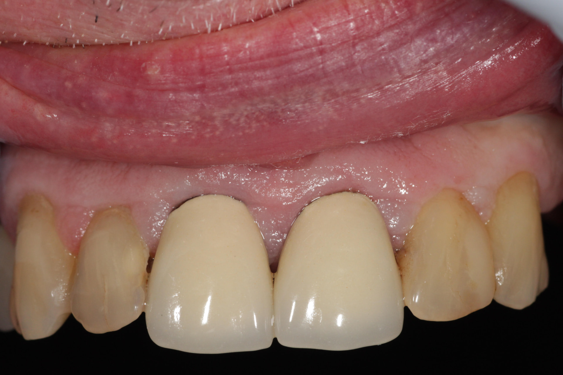 Zirconia crowns - before treatment