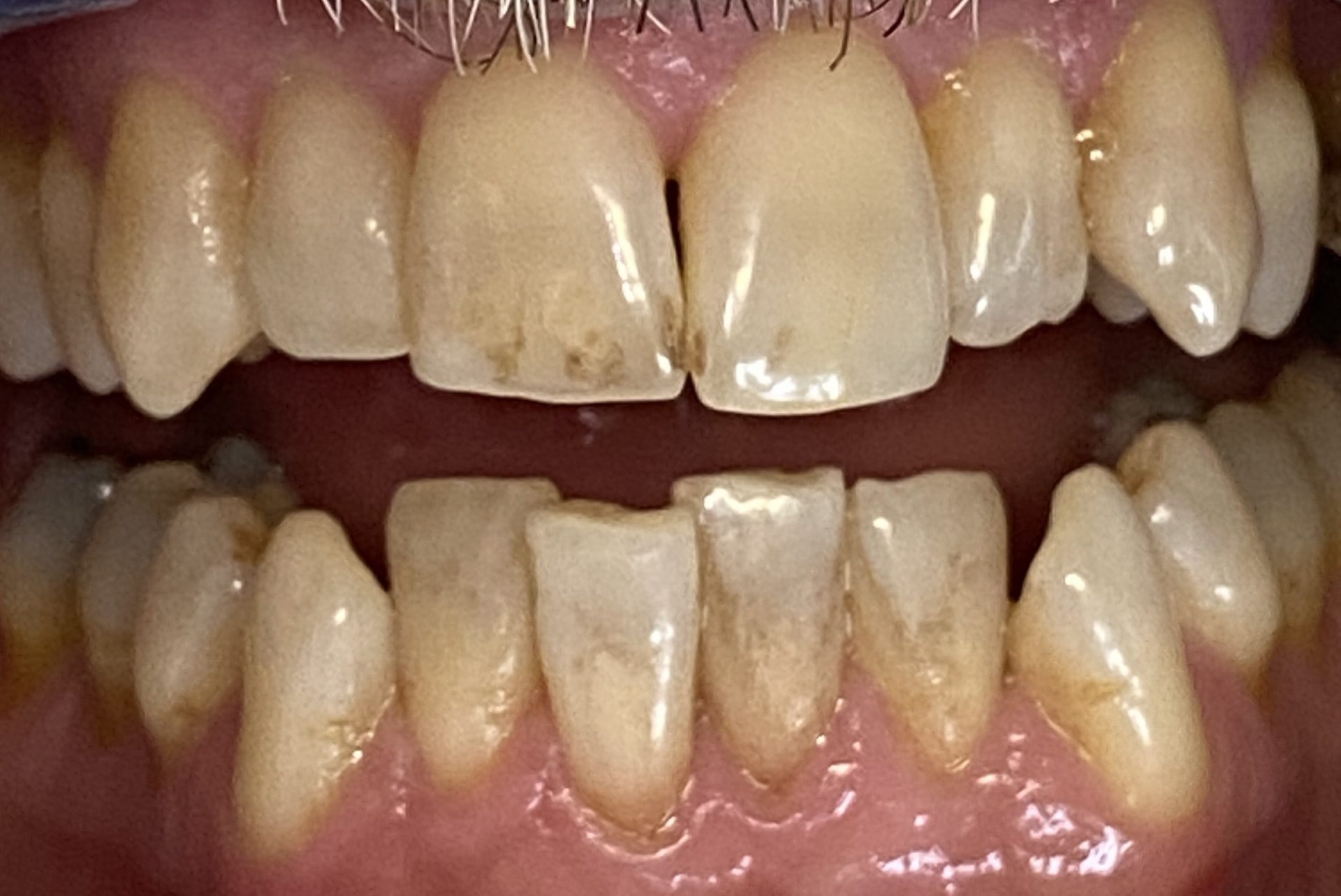 Invisalign result - before treatment