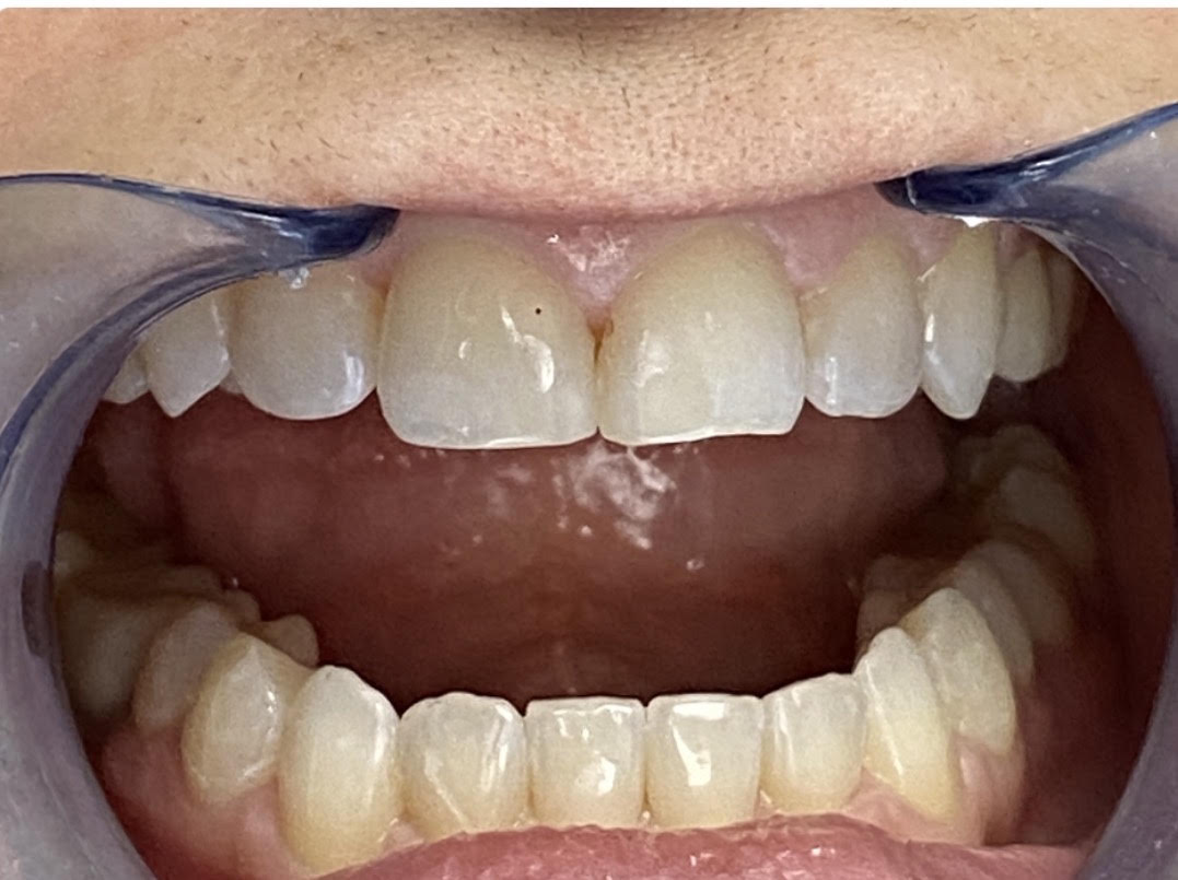 Invisalign alignment - after treatment