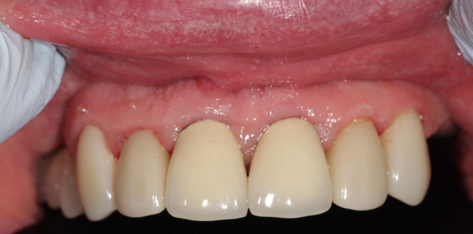 Zirconia crowns - after treatment