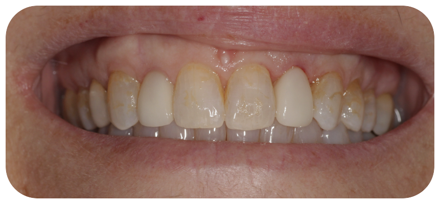 Invisalign, crowns and veneers - after treatment