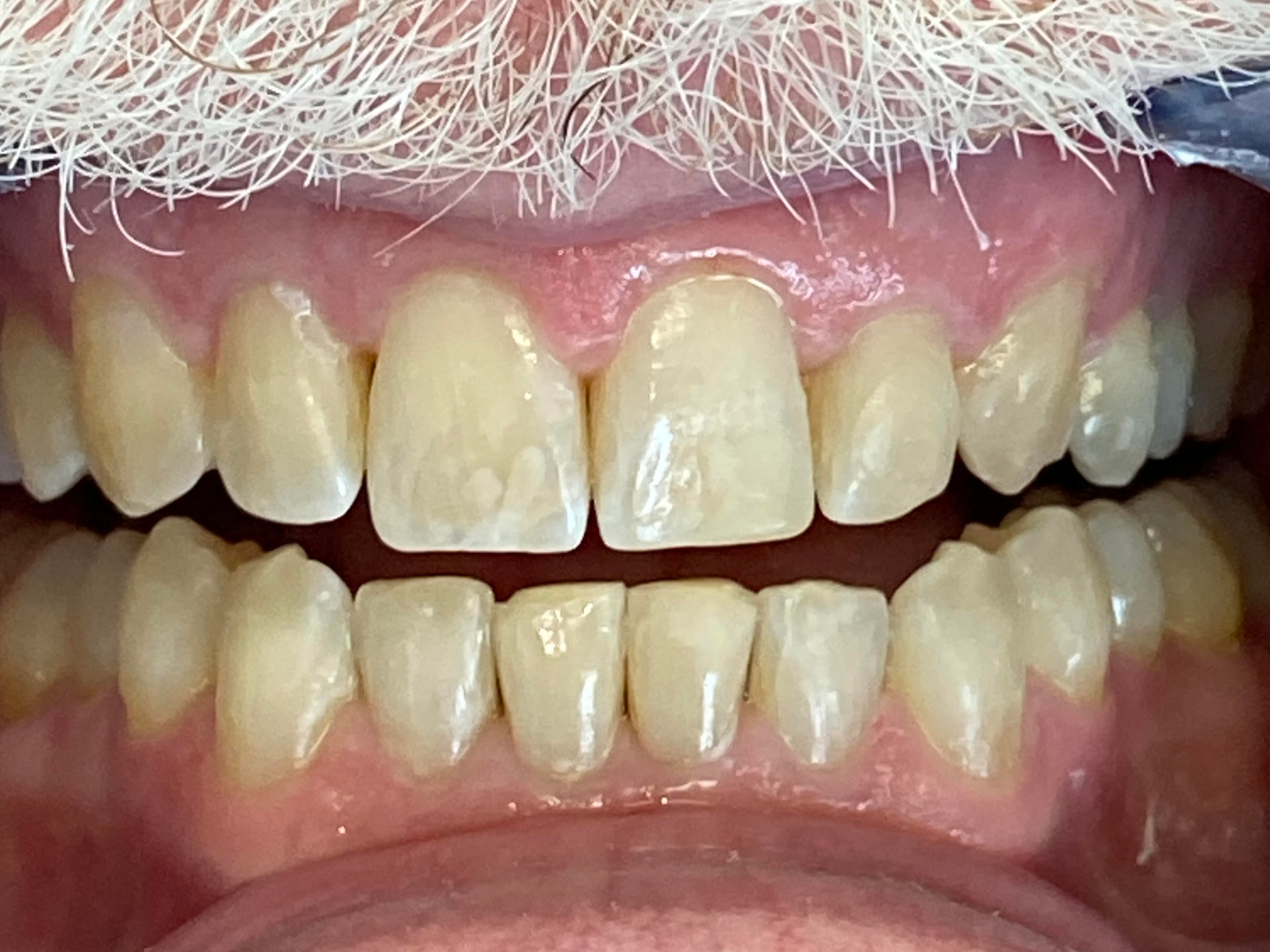 Invisalign smile transformation - after treatment