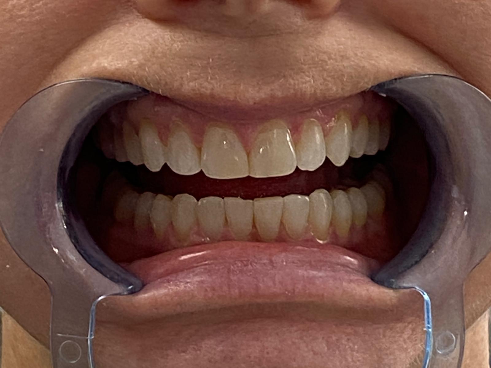 Invisalign treatment - after treatment