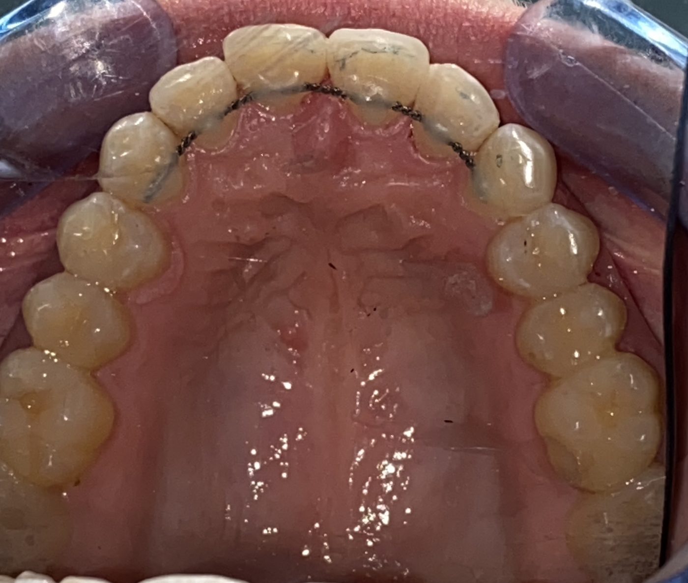 Invisalign upper arch result - after treatment