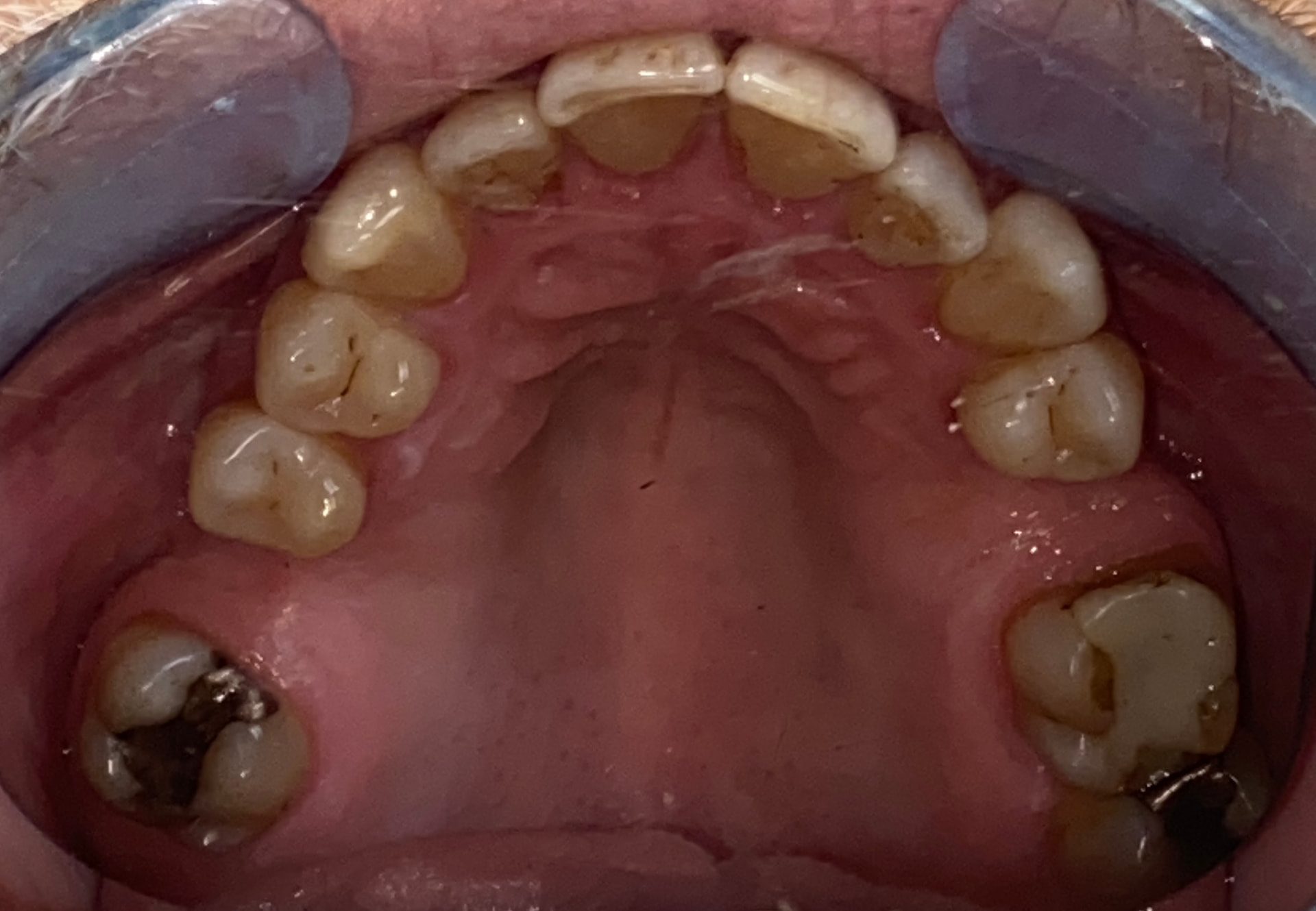 Invisalign upper arch result - before treatment