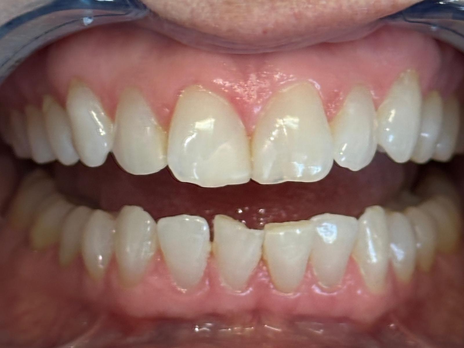 Invisalign treatment - before treatment