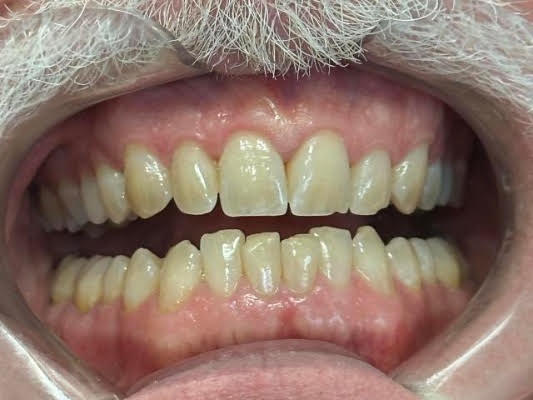 Invisalign smile transformation - before treatment